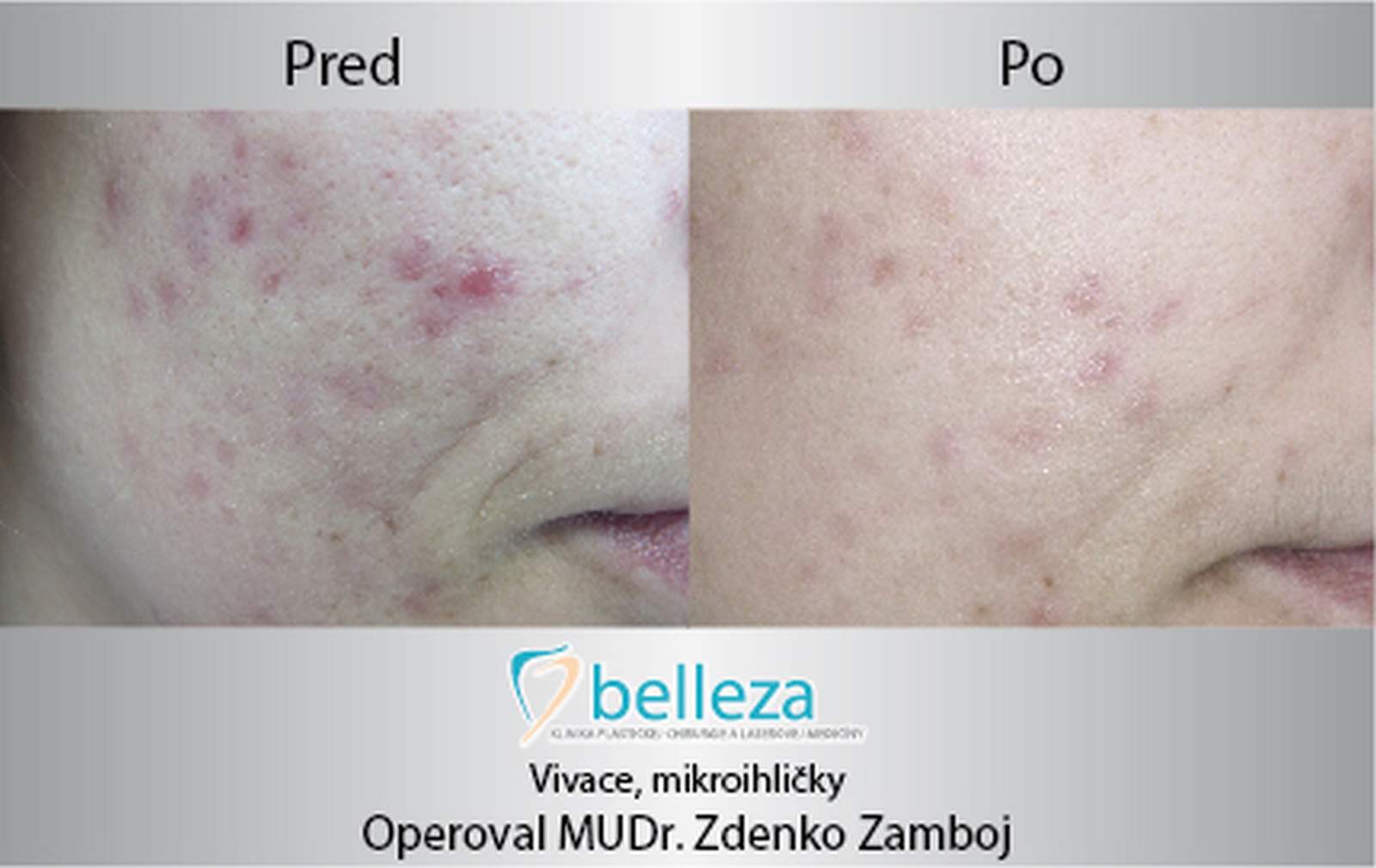 Belleza Centrum Starostlivost O Kozu Chlpky Akne Jazvy Pory Zamboj-vivace 1pec